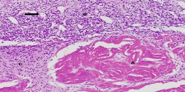 RELATO DE CASO - MIOSITE E NECROSE DE MÚSCULO QUADRADO PLANTAR (M. flexor accessorius) EM LEITÕES - Image 2