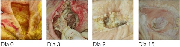 Impacto das úlceras gástricas - Image 5