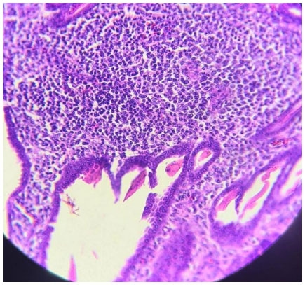 Figura 4. Inflamação linfoplasmohistiocítica de mucosa ventricular (40x)