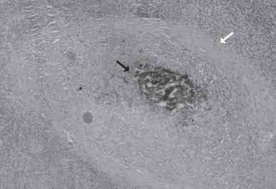 Linfadenite granulomatosa em suínos: linfonodos afetados e diagnóstico patológico da infecção causada por agentes do Complexo Mycobacterium avium - Image 5