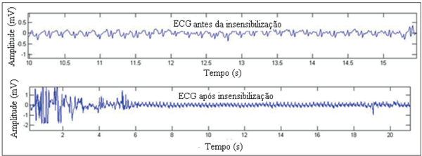 Figura 5. Sinal de ECG antes e após a insensibilização