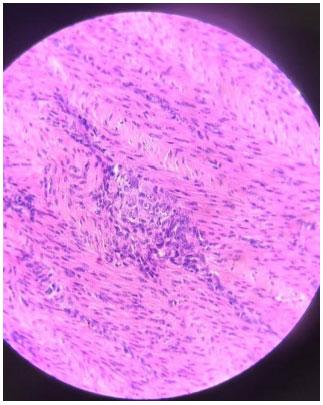 Figura 5. Porção muscular ventricular exibindo miosite proliferativa (40x)