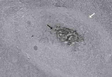 Linfadenite granulomatosa em suínos: linfonodos afetados e diagnóstico patológico da infecção causada por agentes do Complexo Mycobacterium avium - Image 5
