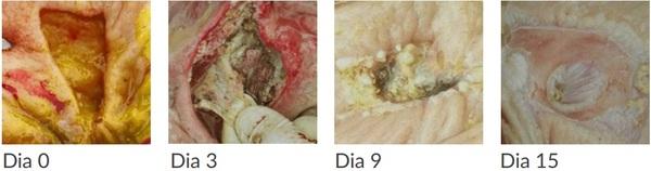 Impacto das úlceras gástricas - Image 5