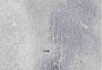 Linfadenite granulomatosa em suínos: linfonodos afetados e diagnóstico patológico da infecção causada por agentes do Complexo Mycobacterium avium - Image 4